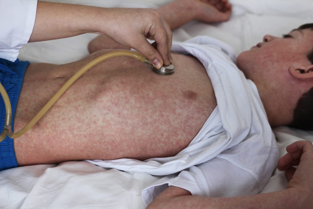 Child with measles